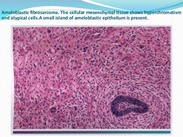 ameloblastic fibrosarcoma